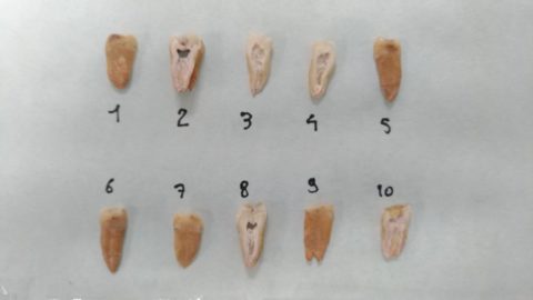 La mort du Caravage élucidée par les équipes de l’IHU Méditerranée Infection